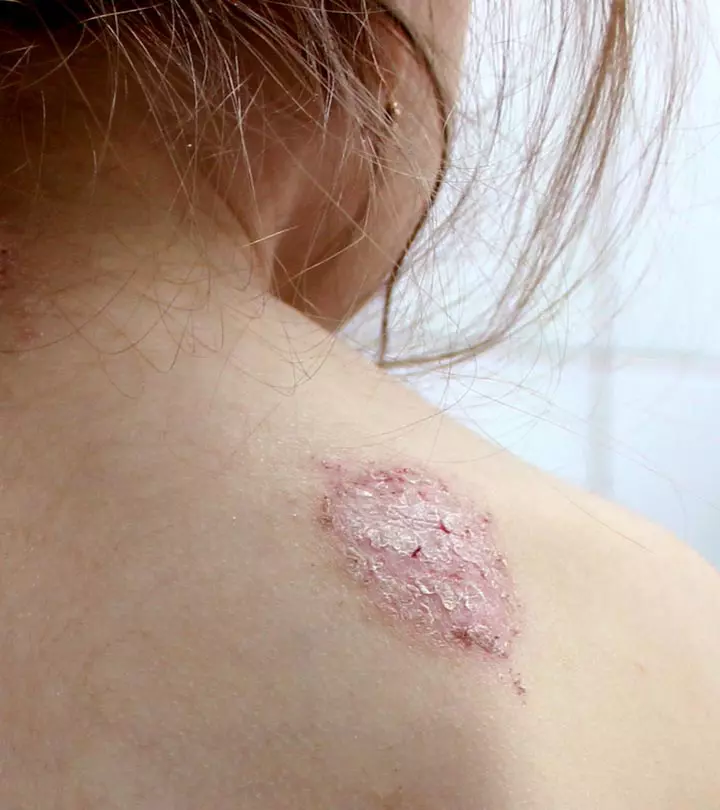 Discoid Eczema: Complete Guide To Symptoms, Causes & Treatment