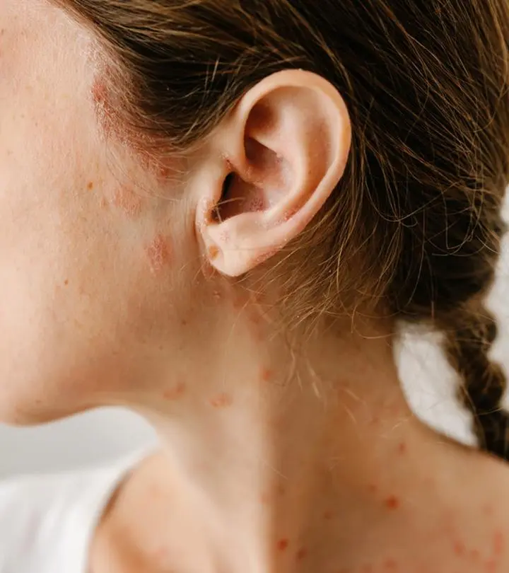 Red Spots On Skin: Causes And 4 Home Remedies For Fast Relief