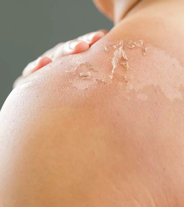 Scaly Skin: 7 Causes, Treatment Options & Prevention Tips