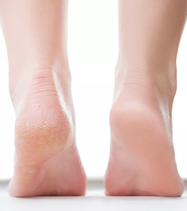 Skin Fissures: 8 Effective Home Remedies And Prevention Tips