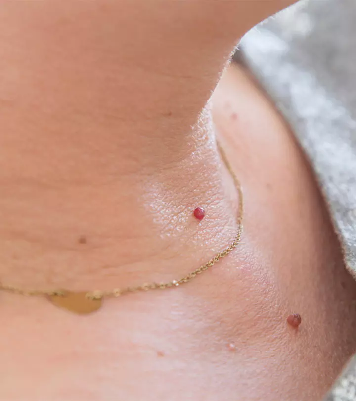 Skin Tags: Causes, Symptoms, And Complete Treatment Guide